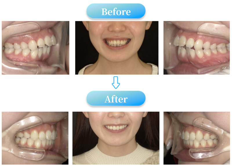 ガミースマイルの症例BeforeAfter画像
