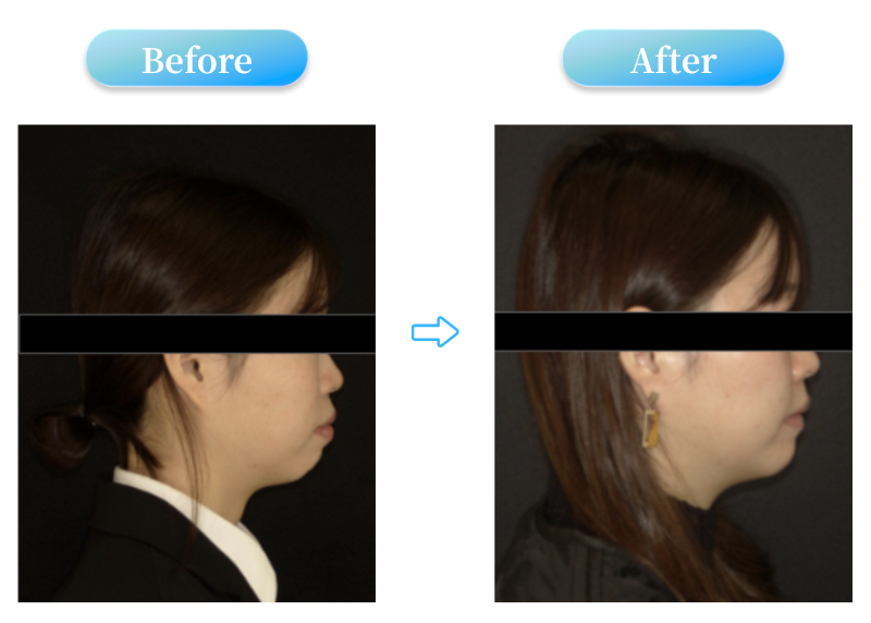 出っ歯症例BeforeAfter画像