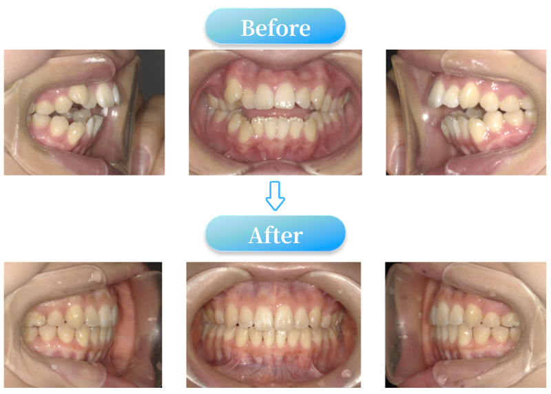 開咬症例BeforeAfter画像
