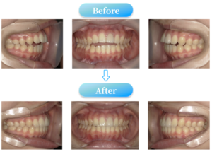 開咬症例BeforeAfter画像