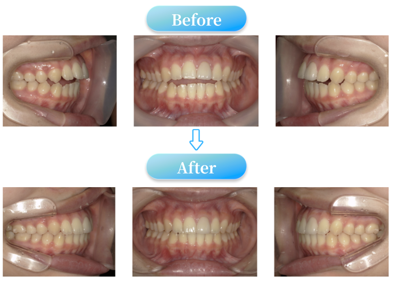 開咬症例BeforeAfter画像