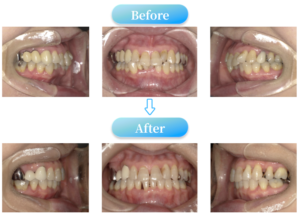 過蓋咬合症例BeforeAfter画像