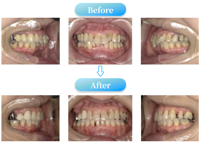 過蓋咬合症例BeforeAfter画像