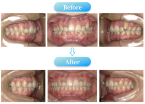 過蓋咬合症例BeforeAfter画像