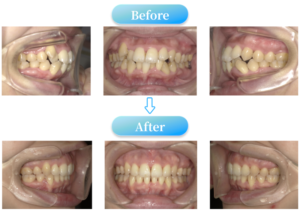 叢生症例BeforeAfter画像