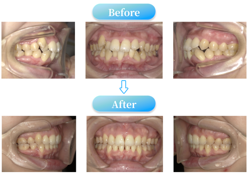 叢生症例BeforeAfter画像