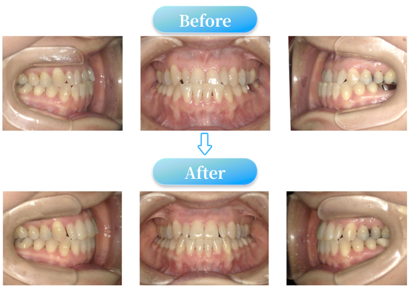 下顎前突症例BeforeAfter画像