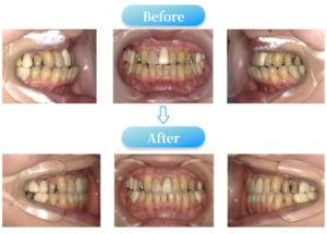 下顎前突症例BeforeAfter画像