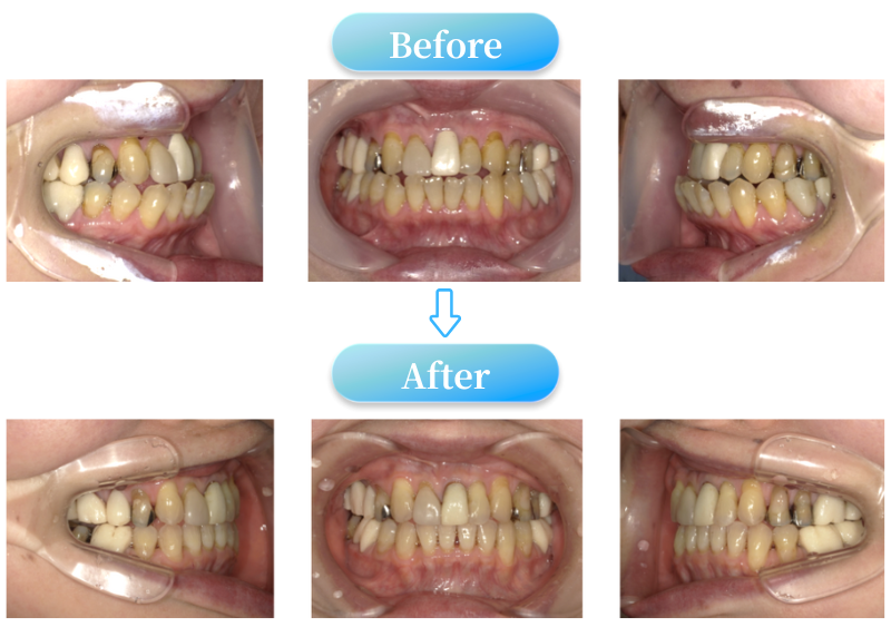 下顎前突症例BeforeAfter画像