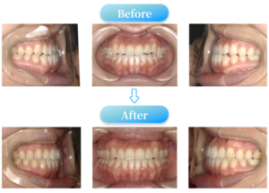 下顎前突症例BeforeAfter画像